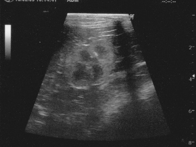嚢胞性腎症のレントゲン写真
